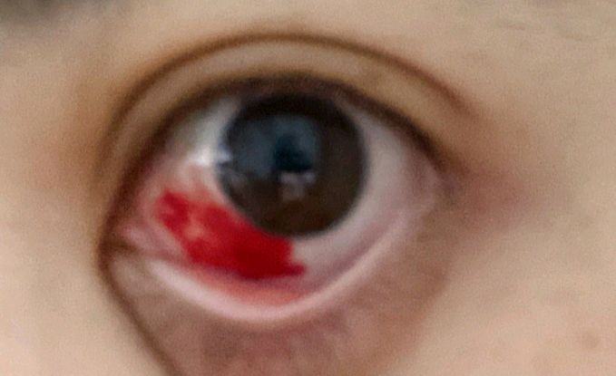 有很多病人找到我,第一句话就是医生,我的眼睛出血了,特别红!