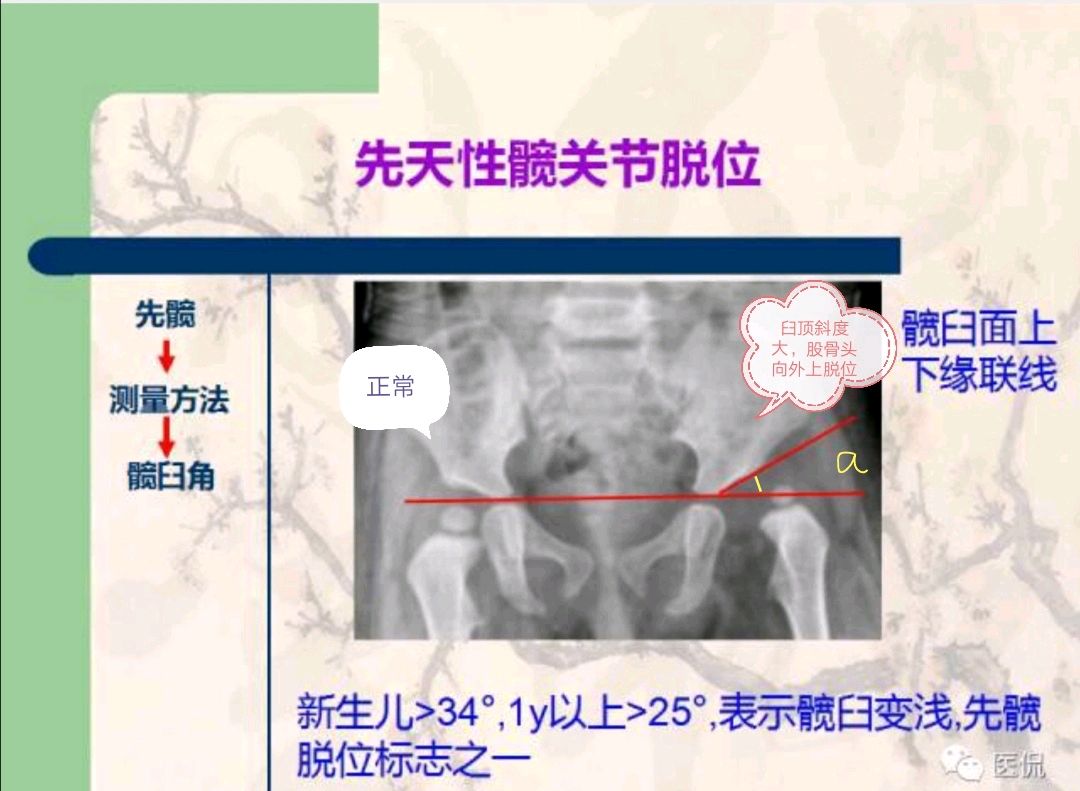 小孩先髋的骨盆测量方法