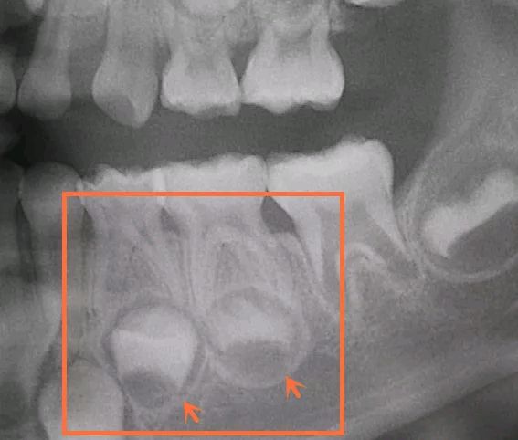 乳牙和恒牙x光图图片