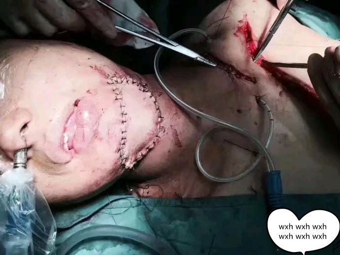 以下绝对是真实的口腔癌手术部分照片,希望能引起广大槟榔爱好者的