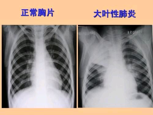 关于肺炎支原体感染引起的大叶性肺炎