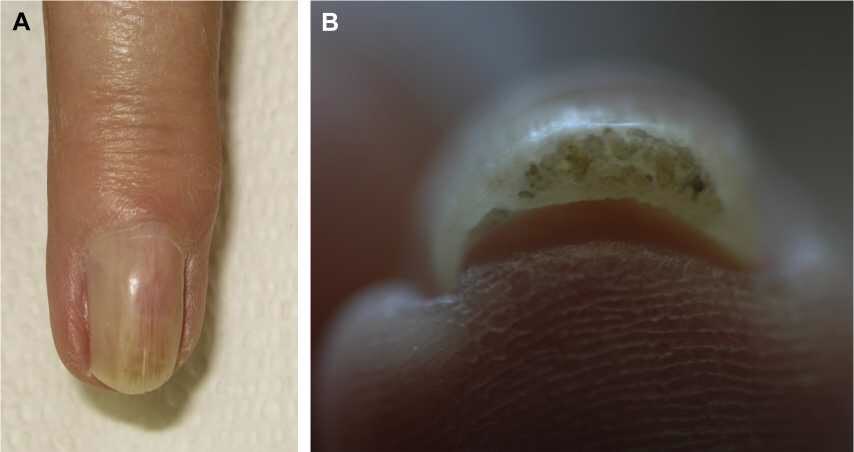 什么是甲母质瘤