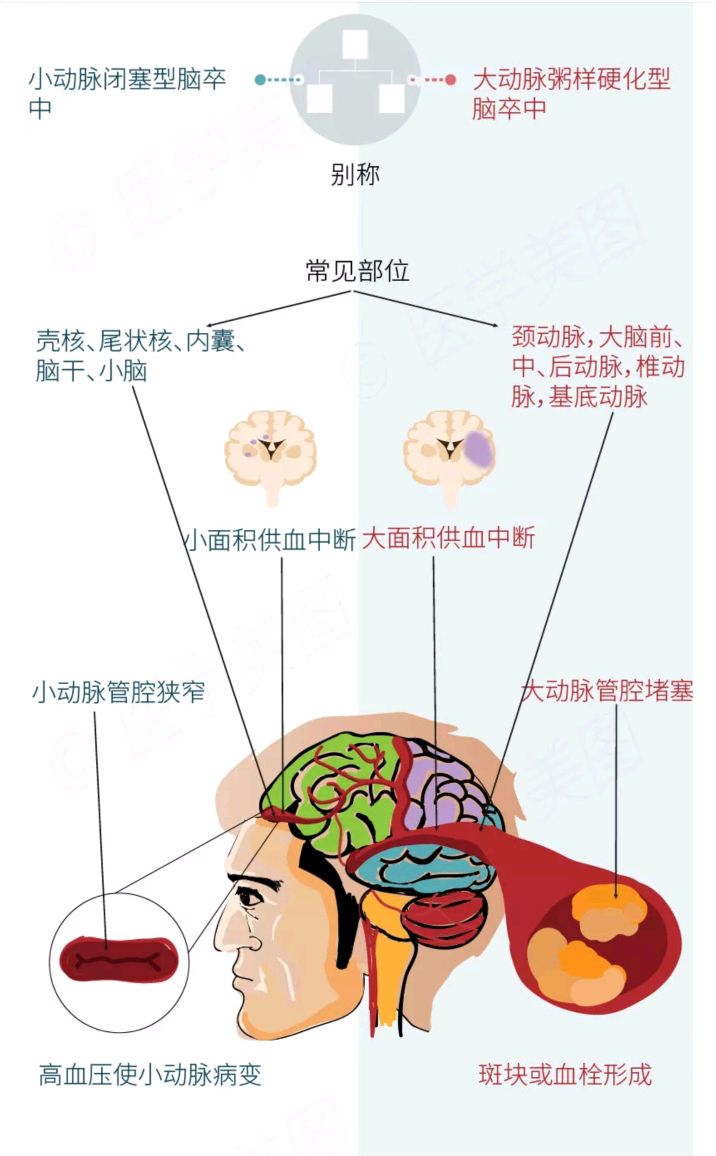 腔隙性脑梗塞与脑梗塞不同(让您一图读懂) 