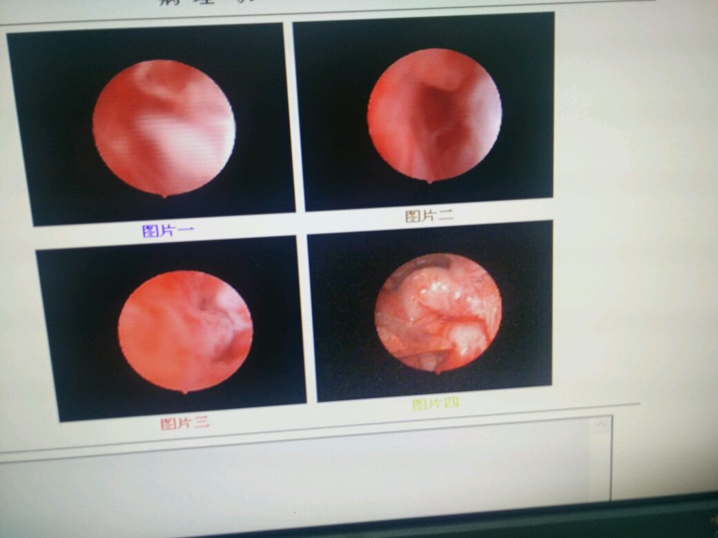 患者不规则阴道流血,b超提示子宫腔占位,下图是宫腔镜检查图片,各位