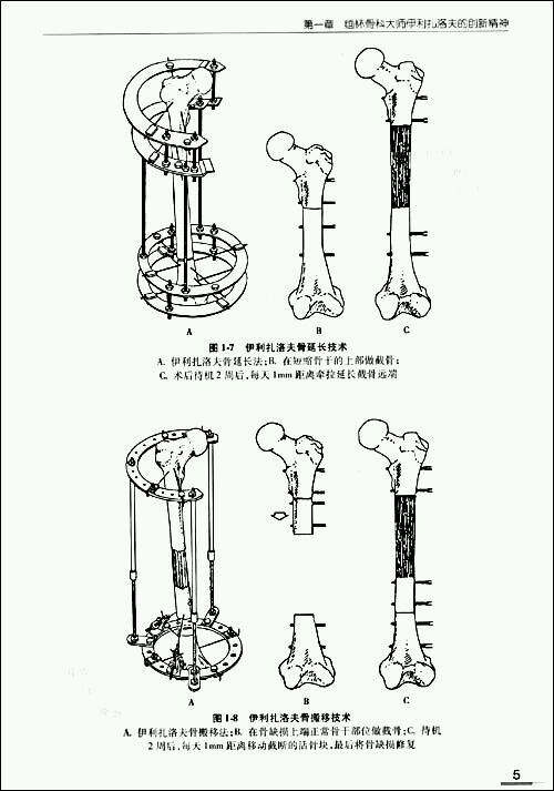 伊利扎洛夫(ilizarov)技术包括环形外固定,骨延长