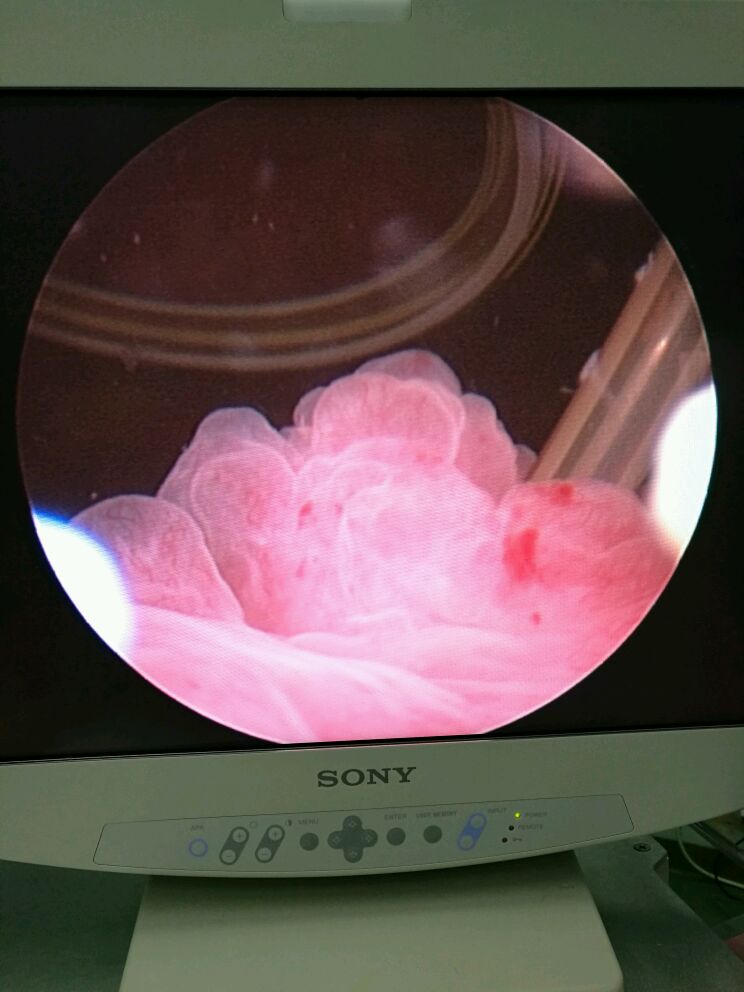 放射性膀胱炎图片图片