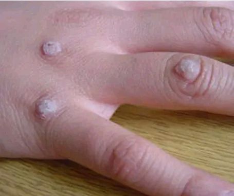 手上脸上的疣哪些是hpv导致的6种常见疣的区分和治疗