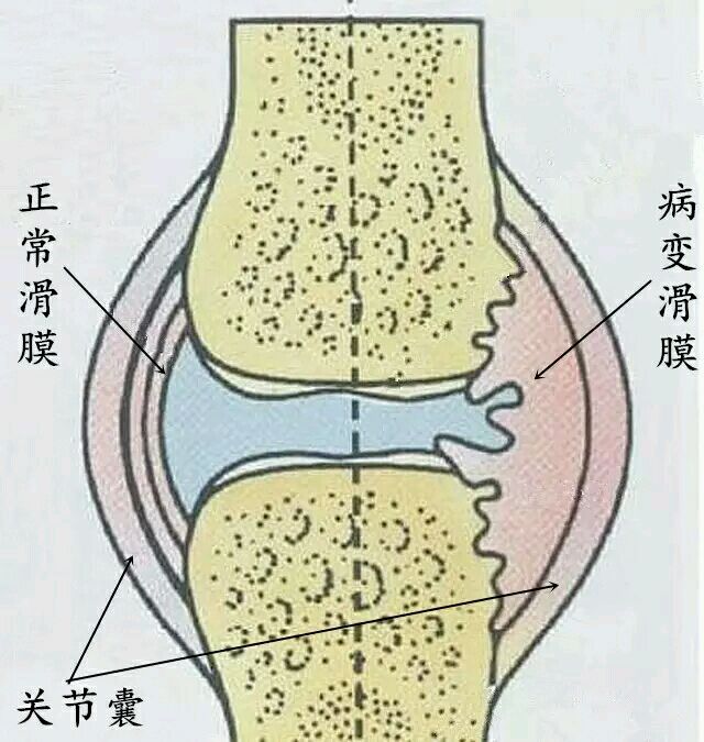 滑膜囊示意图图片